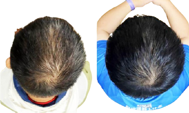 Before and after comparison of a person's hair growth on the back of their head.